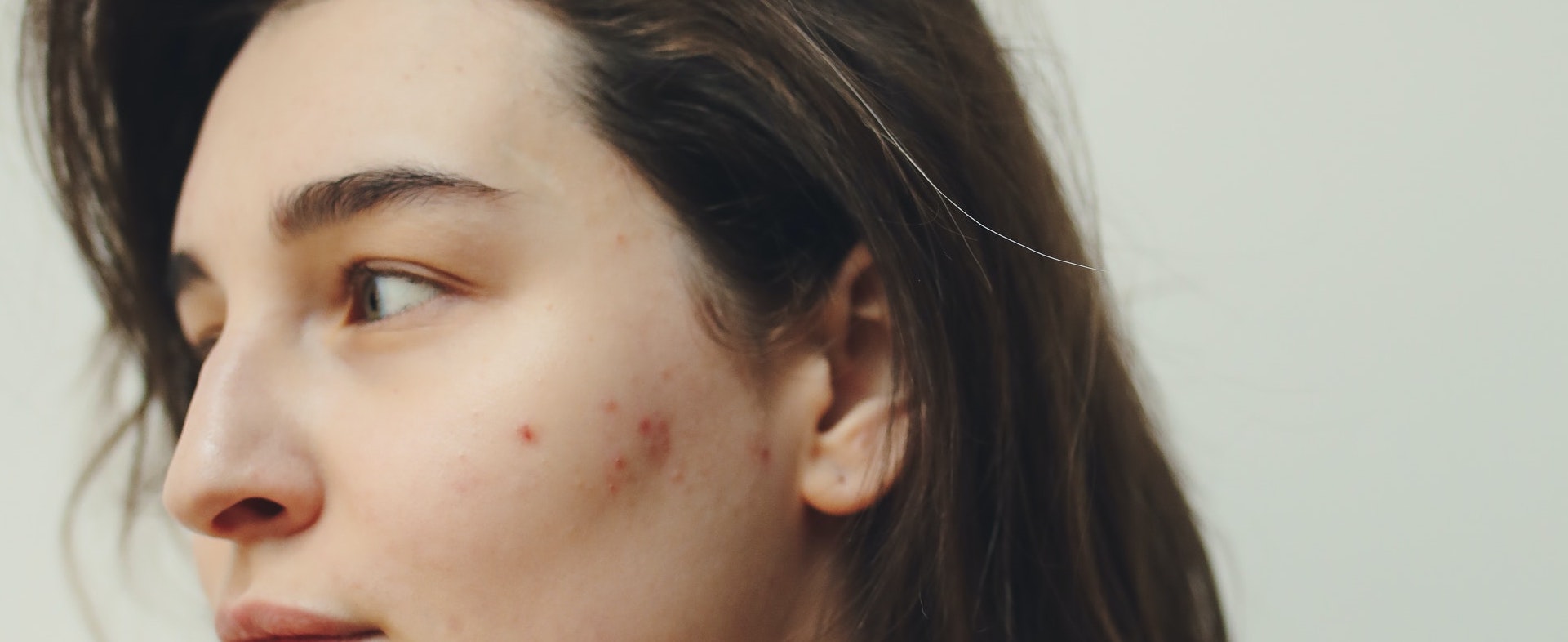 woman's face representing alcohol-related skin issues
