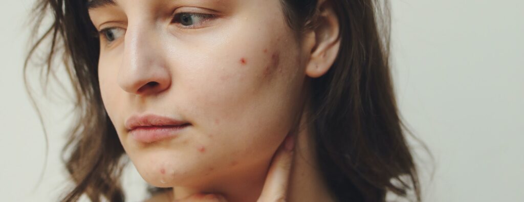 woman with face sores representing meth sores